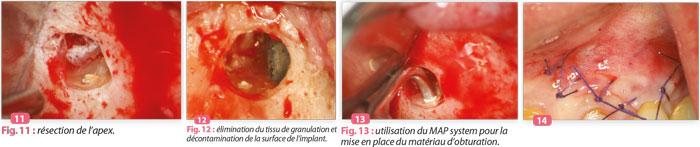 APPORT-DU-LASER-ERBIUM-YAG-EN-ENDODONTIE-CHIRURGICALE