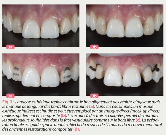 alignement-des-zeniths-gingivaux