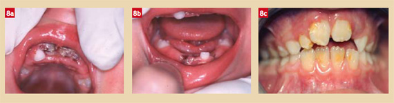 Fig. 8 : Expulsion de 6 dents temporaires qui ne sont pas réimplantées (8a, 8b). Situation 7 ans plus tard : lésions des dents permanentes antérieures (8c).