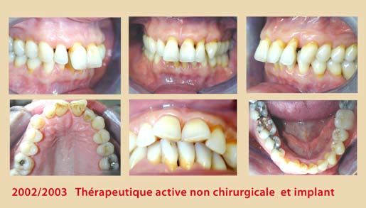 Le détartrage : les différentes techniques existantes