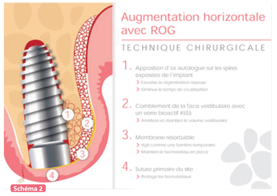 augmentation horizontale avec ROG technique chirurgicale