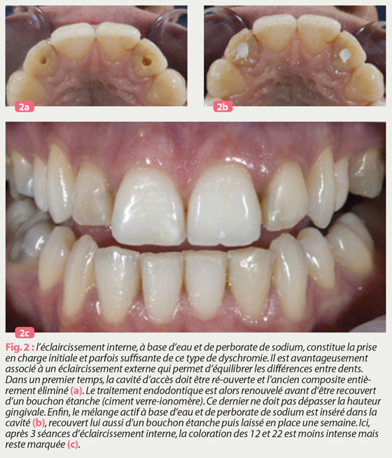 bouchon-étanche-traitement-endodontique