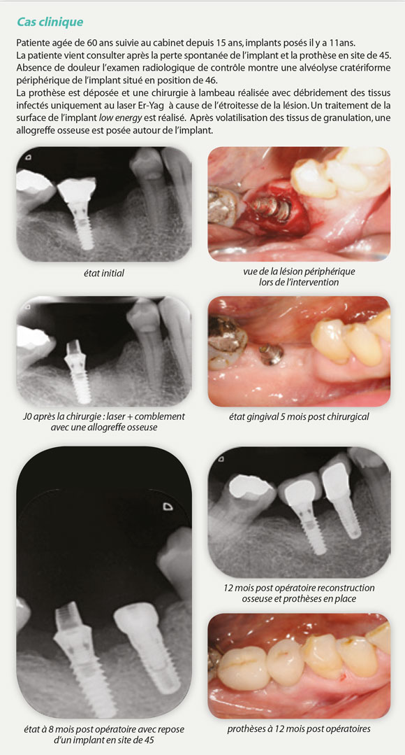 cas-clinique-implants