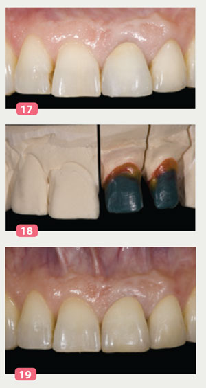 cfao-indirecte-cas-clinique-4