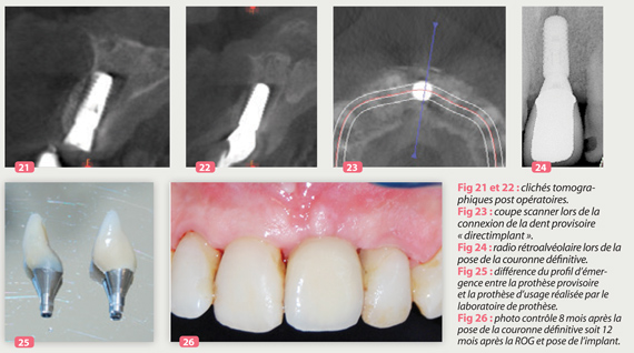 cliches-post-operatoires-biomateriaux