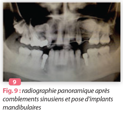 comblements-sinusiens-et-pose-dimplants-mandibualires