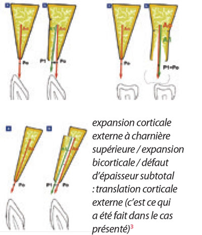 expansion-corticale