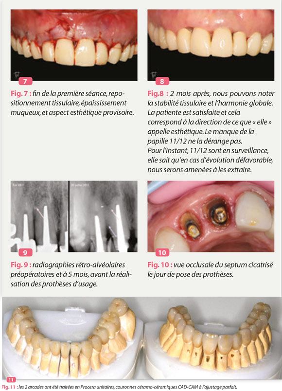 extraction-greffe-os-implants