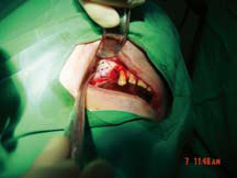 Voie d’abord latérale de la fenêtre osseuse maxillaire (réalisée fraise boule+scie diamantée)