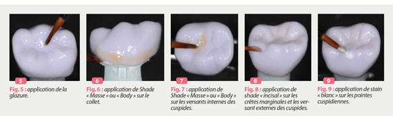 ETAPES DE REALISATION D'UNE COURONNE DENTAIRE