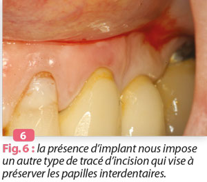 papilles-interdentaires