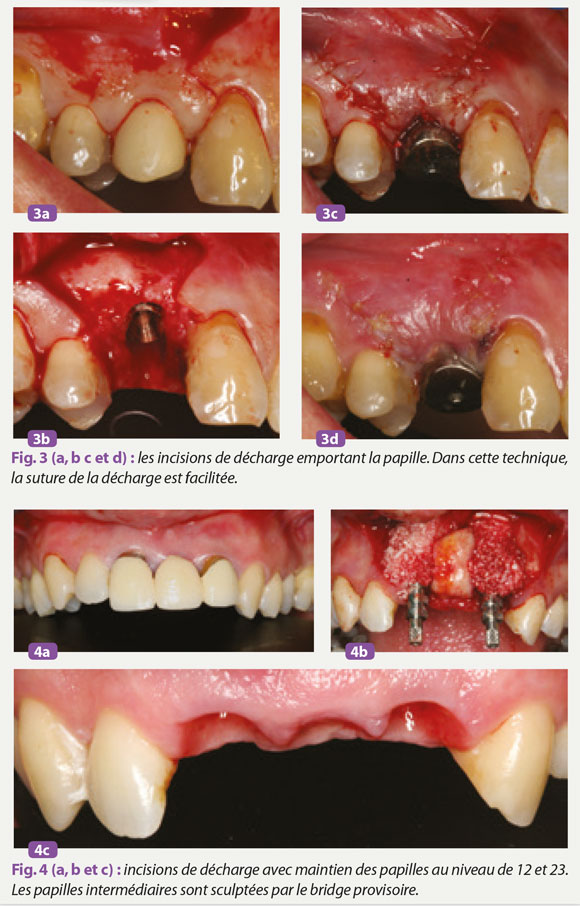 papilles-intermediaires-sculptees-par-bridge-provisoire