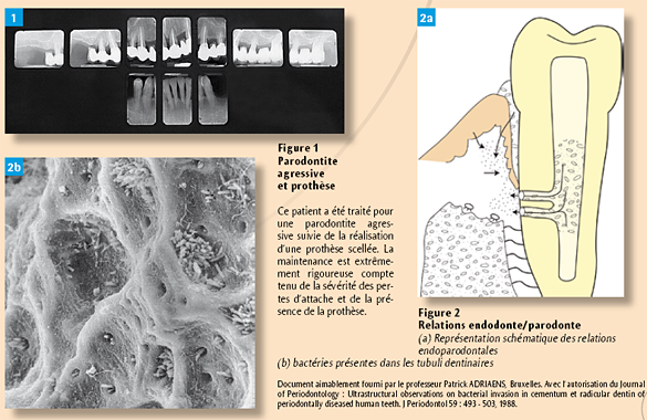 Parodontite agressive et prothèse