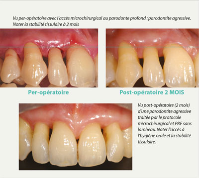 protocole-microchirurgical-et-prf-sans-lambeau