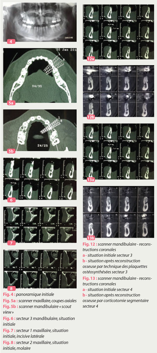 reconstruction-osseuse-par-corticotomie-segmentaire