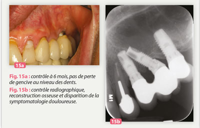 reconstruction-osseuse