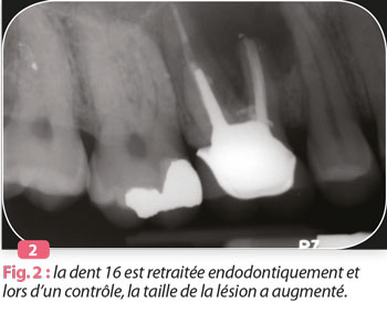 traitement-endodontique