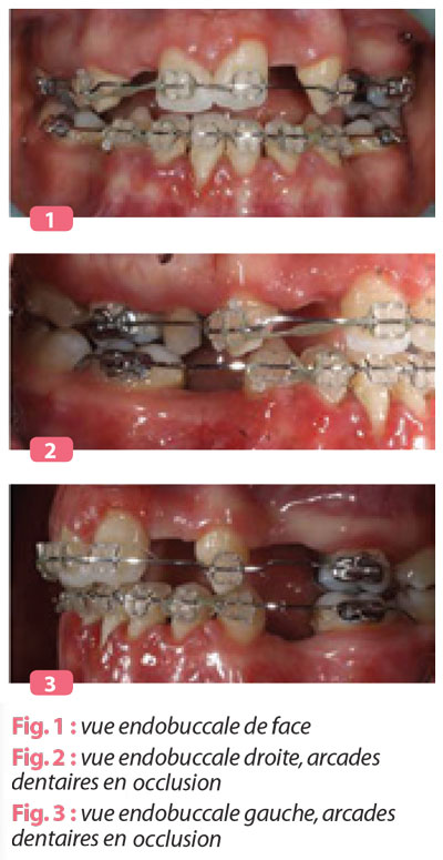 vue-endobuccale-arcade-dentaire-en-occlusion