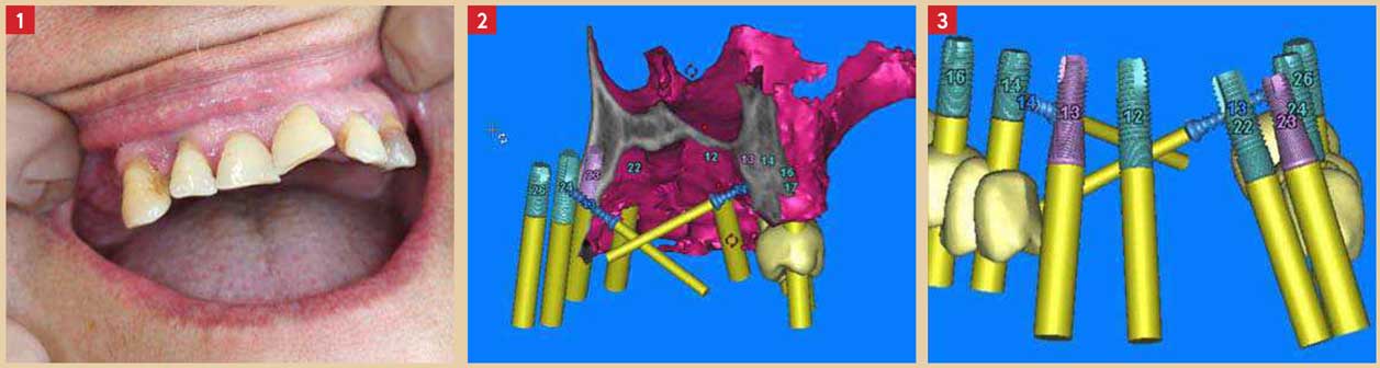 Fabrication-du-guide-chirurgical