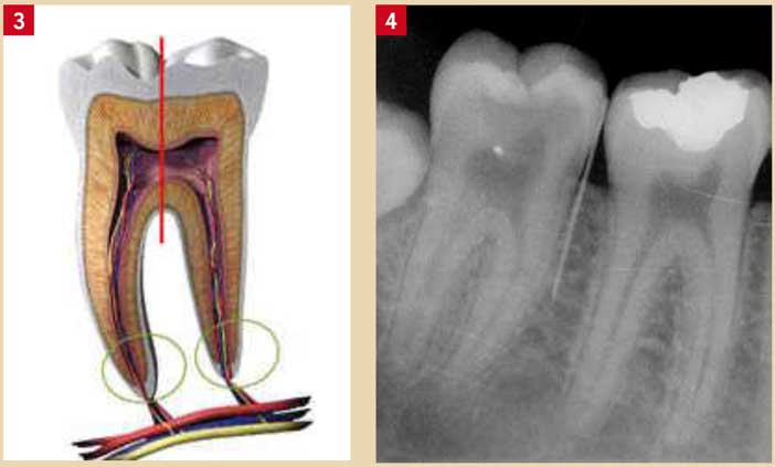 La-pathologie-pulpaire