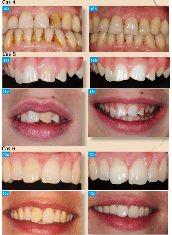 Technique d'éclaircissement sur dents dépulpées