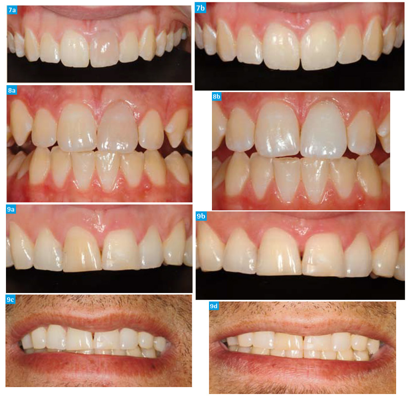 Technique d'éclaircissement sur dents dépulpées