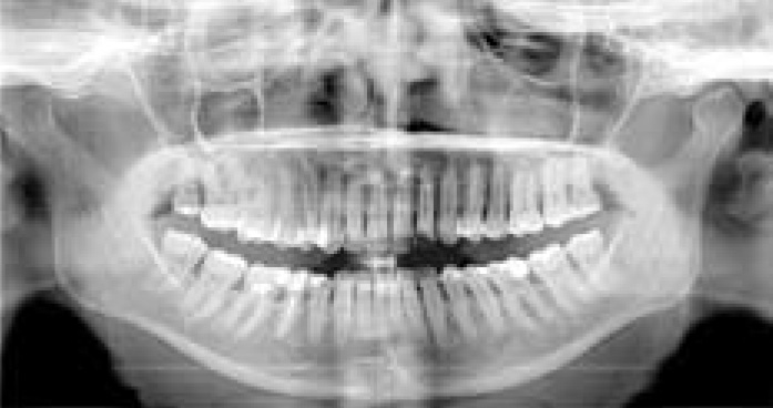 panoramique-dentaire
