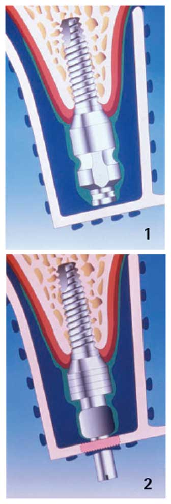 sirona-laser-advance_design