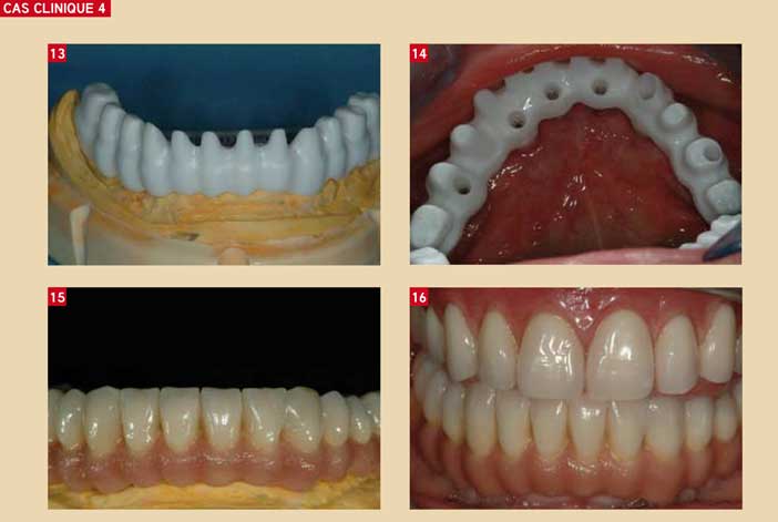 Armature-en-Zircone