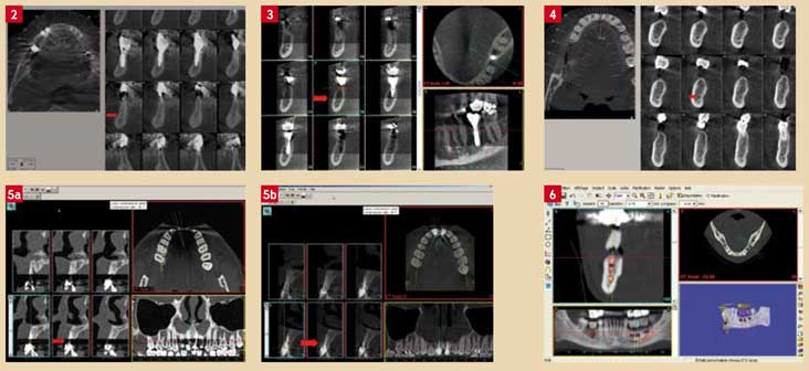 Artéfacts-et-limites-du-Cone-Beam