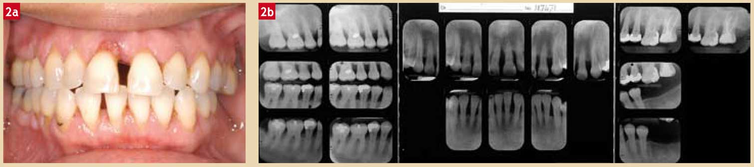 Bilan-radiographique