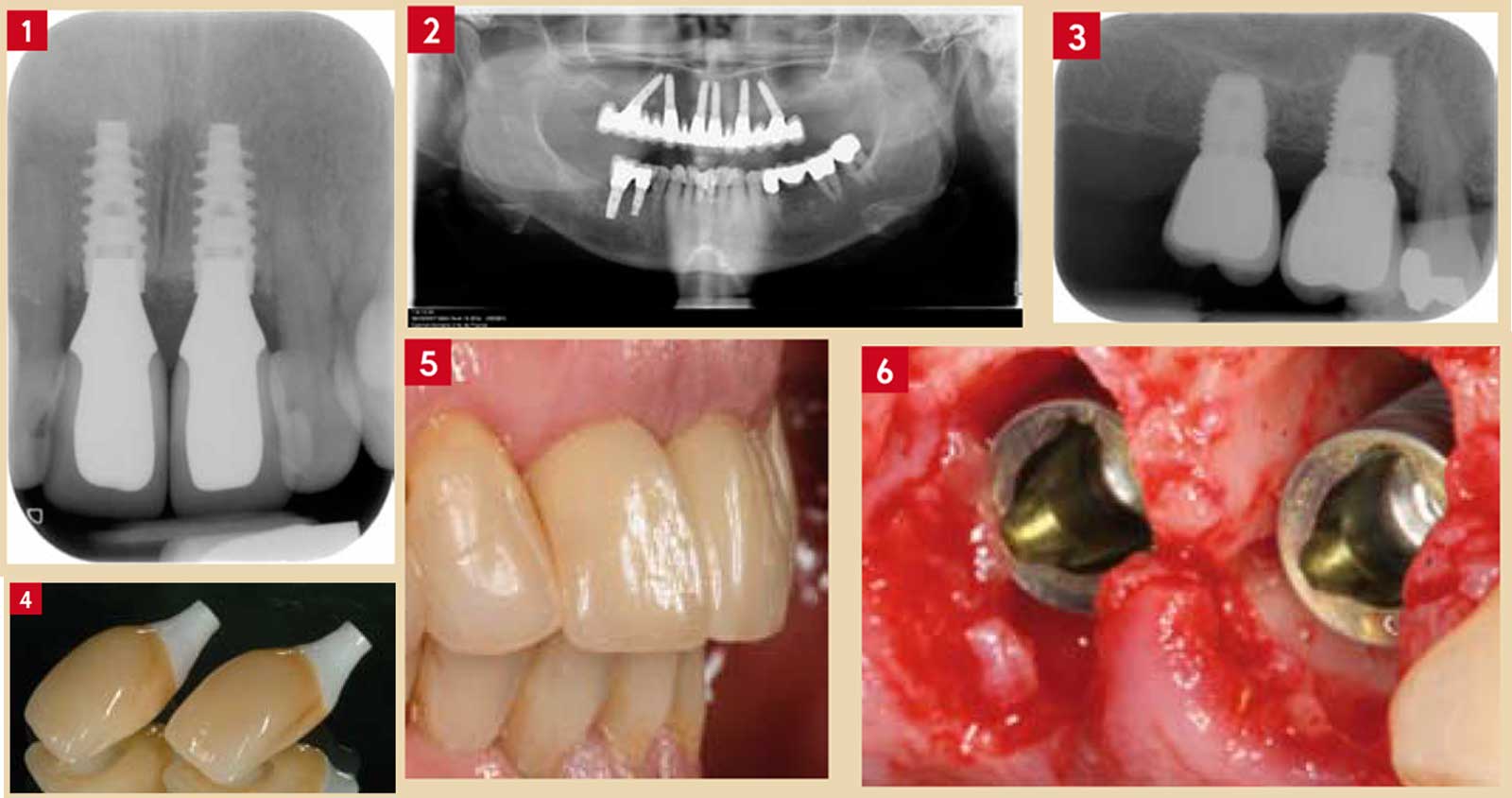 Deux-implants-courts-et-de-large-diamètre