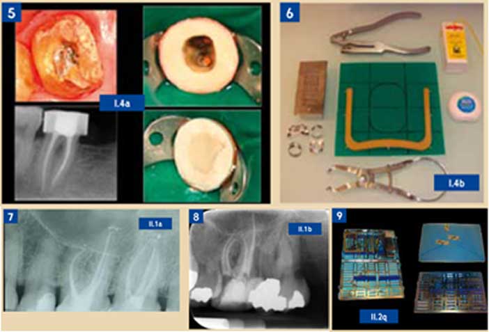 Endodontie-versus-Implantologie