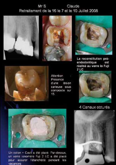 Fiche-de-traitement-endodontique