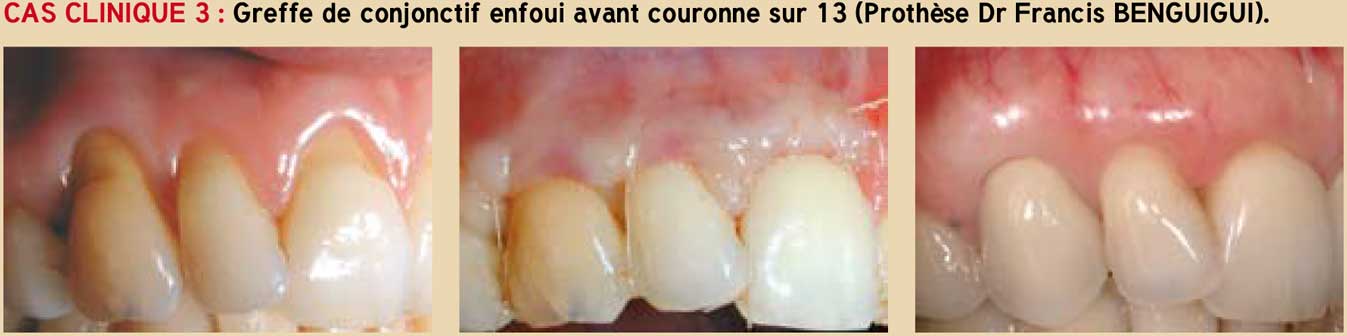 Greffe-de-conjonctif-enfoui-avant-couronne