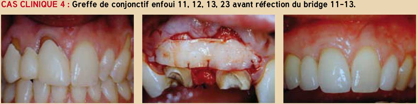 Greffe-de-conjonctif-enfoui