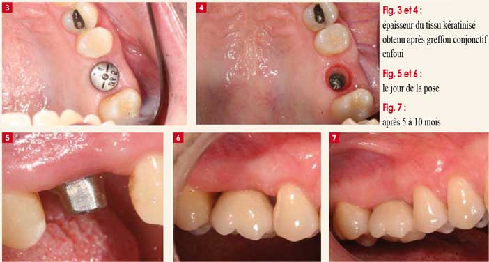 Inflammation-et-péri-implantite