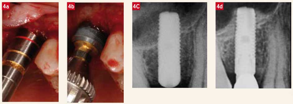 Insertion-manuelle-d-implant