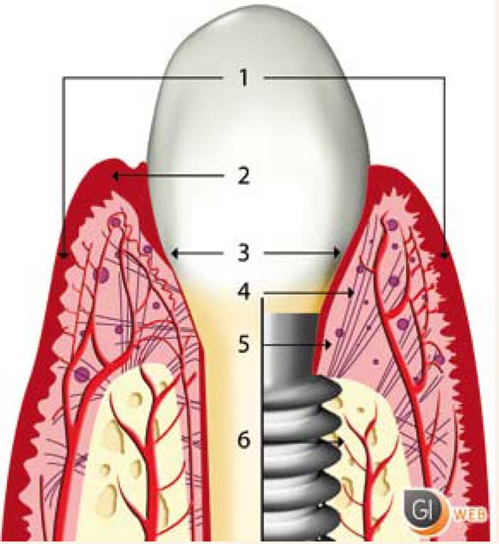 L-ostéointégration-d-implants