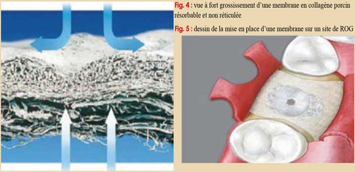 Les-biomatériaux-de-comblement-osseux