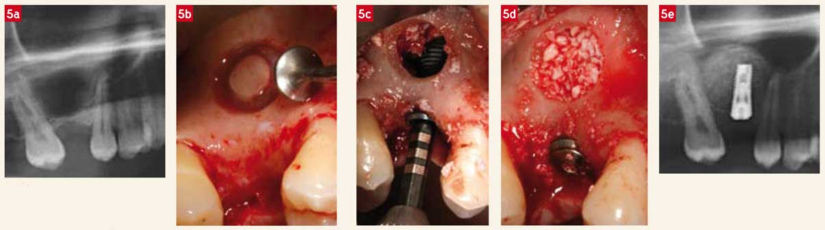 Mise-en-place-de-l’implant