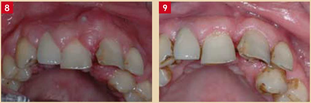 Parodontite-chronique