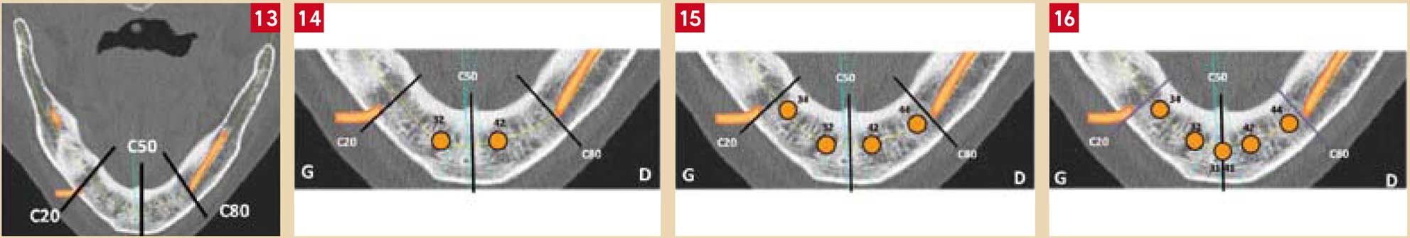 Planification-de-cinq-implants