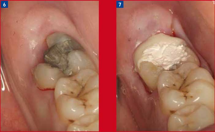 Prolifération-gingivale