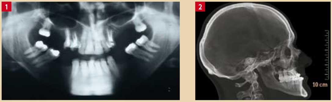 Téléradiographie-du-crâne-de-profil