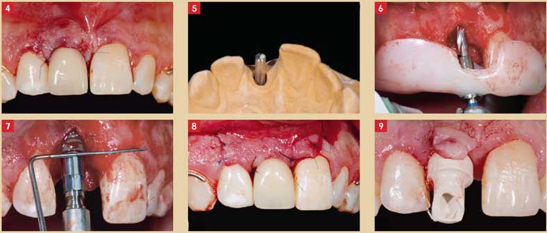 Un-implant-Straumann