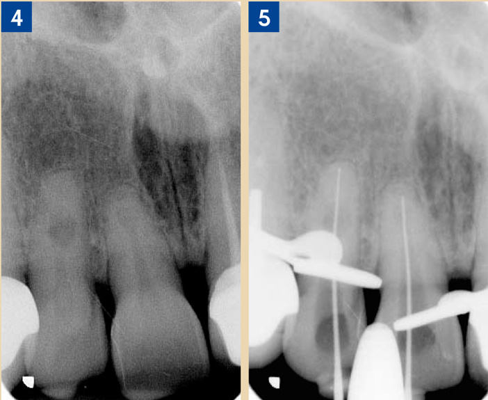 Un-traitement-endodontique