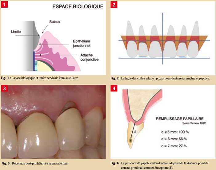 Unité-dento-gingivale