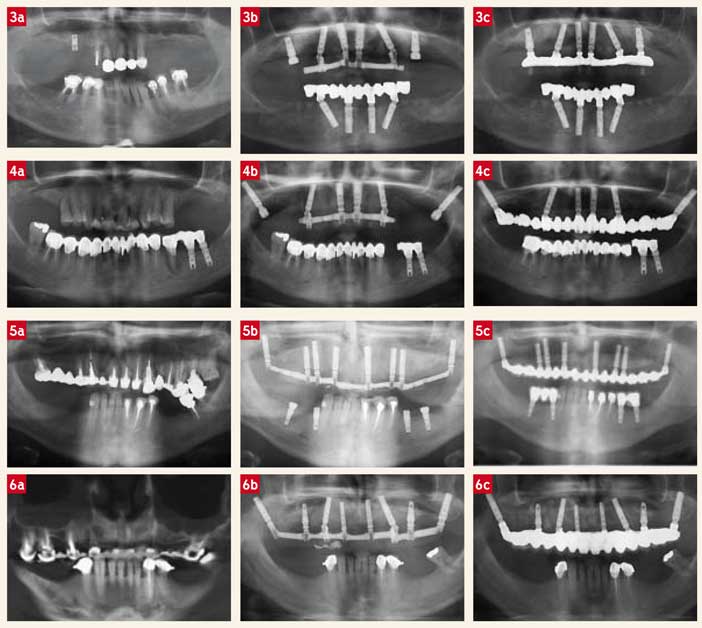 comblements-de-sinus