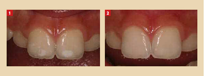 comprendre-et-pratiquer-la-micro-abrasion-amelaire-1-2